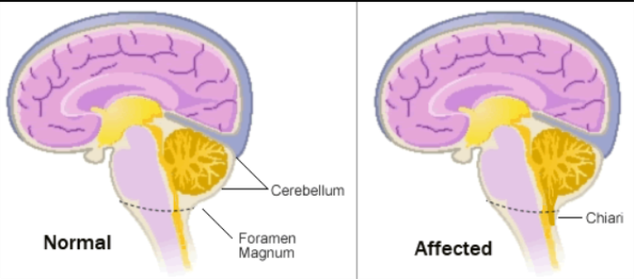 Overview of Chiari Malformation Types and Causes