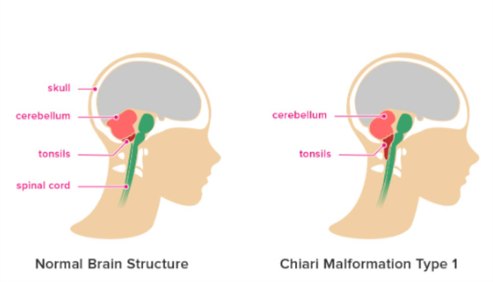 The Impact of Brain Infections on Chiari Malformation