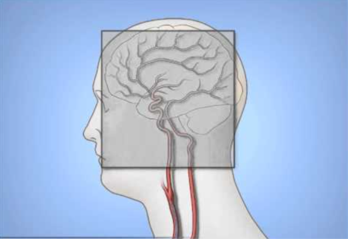 Angiography for Diagnosing Vascular Conditions at the Skull Base