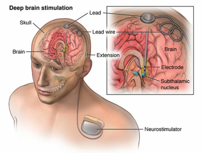 Deep Brain Stimulation (DBS) Surgery