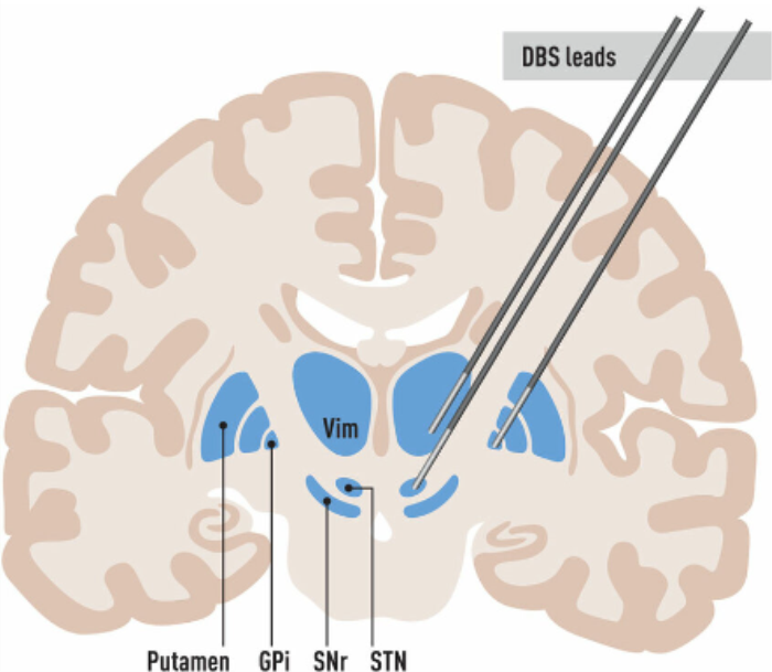 Target Areas for DBS in the Brain: GPi, STN, and Thalamus