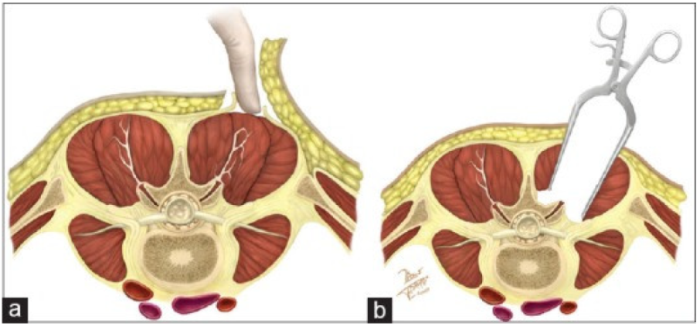 Why Minimally Invasive Surgery? Benefits and Outcomes