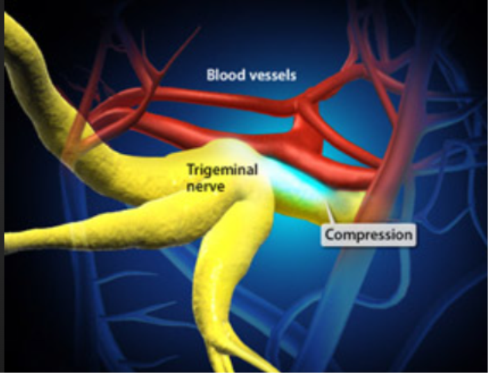 The Role of Blood Vessel Compression in Neurological Disorders