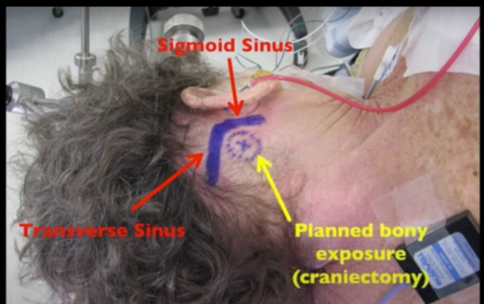 What Is Microvascular Decompression (MVD) Surgery