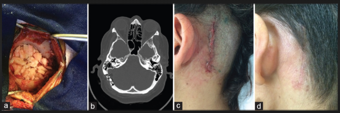 What Happens After Microvascular Decompression Surgery