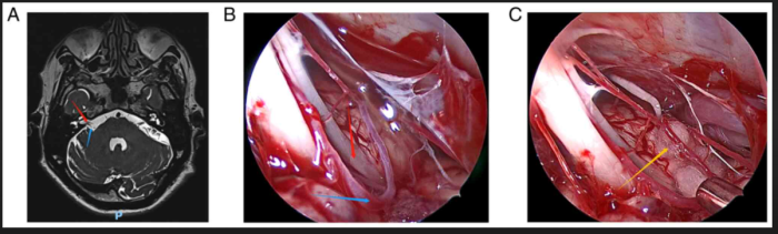 Recovery After Microvascular Decompression Surgery