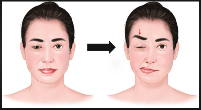 Can <b>Hemifacial Spasm</b> Be Managed Without Surgery