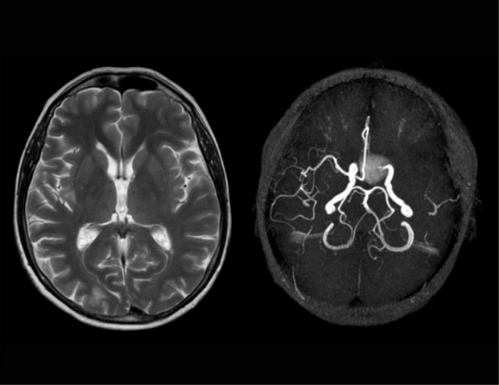 The Role of Imaging in Aneurysm Detection