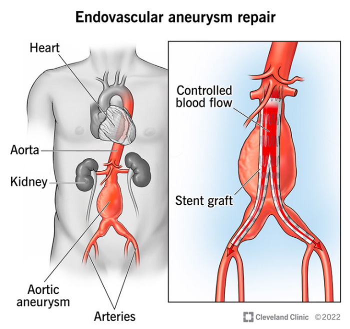 What Is Endovascular Repair? An Overview