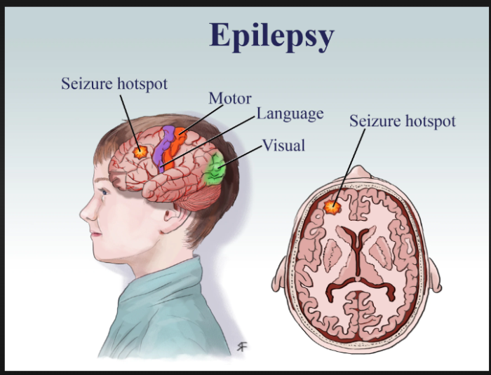 Introduction to Epilepsy Surgery: Why Is It Considered