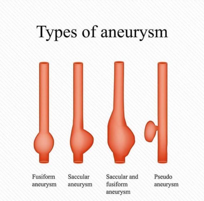 Types of Aneurysms and Their Implications