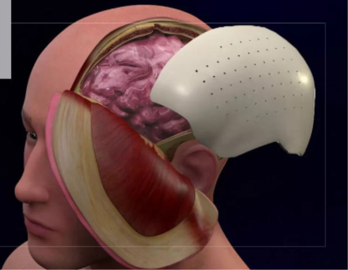 Best Surgery for Cranioplasty treatment in India