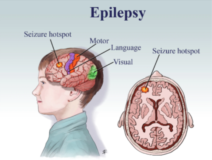 Best Hospital for Epilepsy Surgery in India