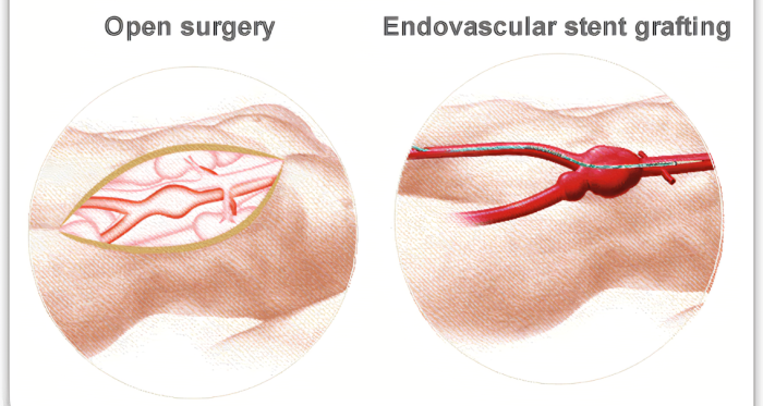 Best Aneurysm Repair Surgery Hospitals in India