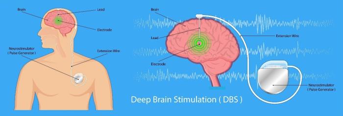 what is Deep Brain Stimulation (DBS) Surgery