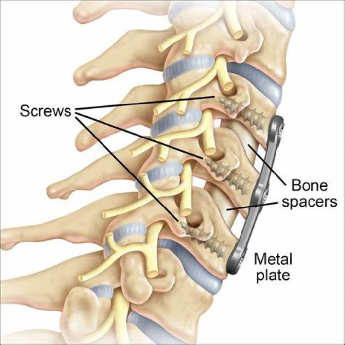 Latest treatment for spinal cord in India