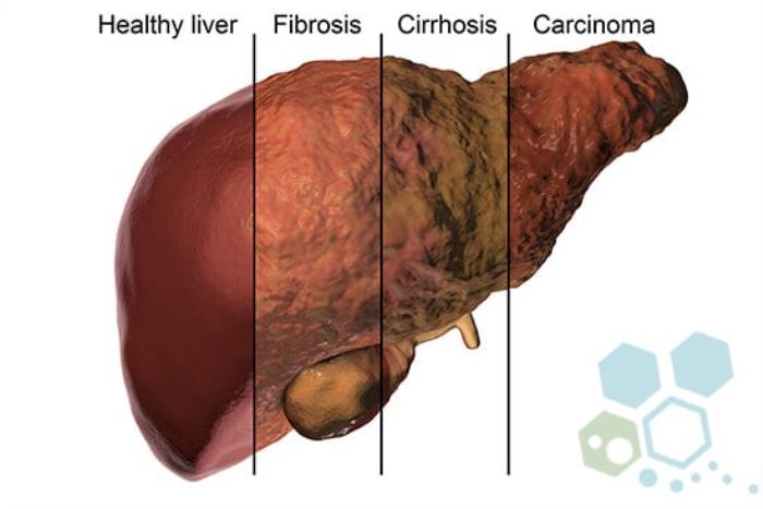 Liver Cancer treatment Challenges