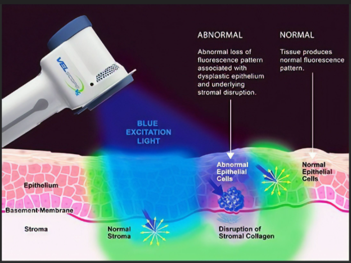 Non-Invasive Diagnostic Tools for Oral Cancer Detection