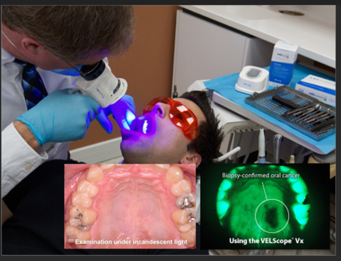 Light-Based Diagnostic Tools(Non-invasive) for Oral Cancer Detection - Autofluorescence Imaging