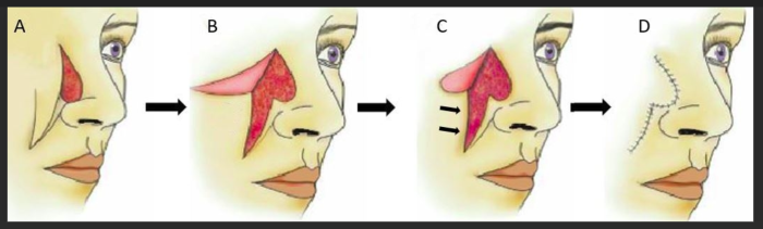 Melolabial Flap Oral or Mouth Cavity Reconstruction