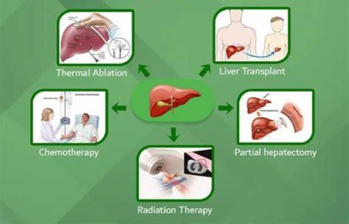 Best liver cancer therapies