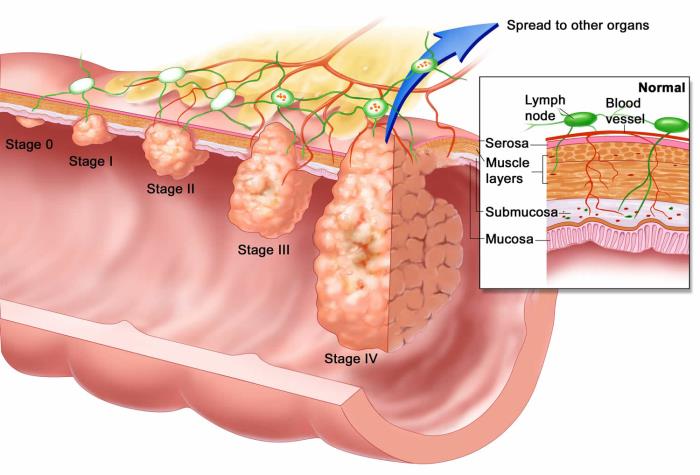 Understanding the Stages of Esophageal Cancer