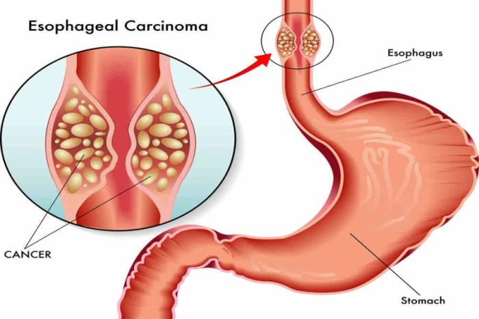 Difficulties Faced by Patients with Esophageal Cancer