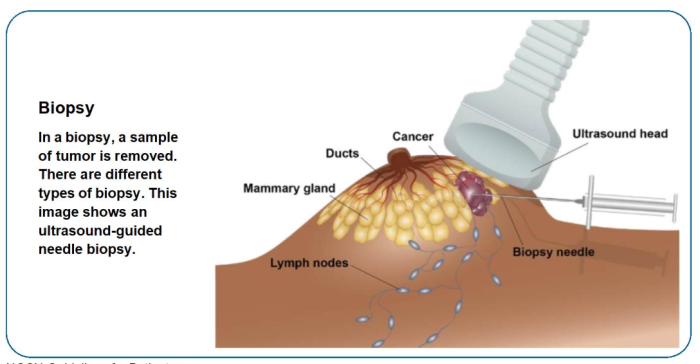 How is Breast Cancer Diagnosed