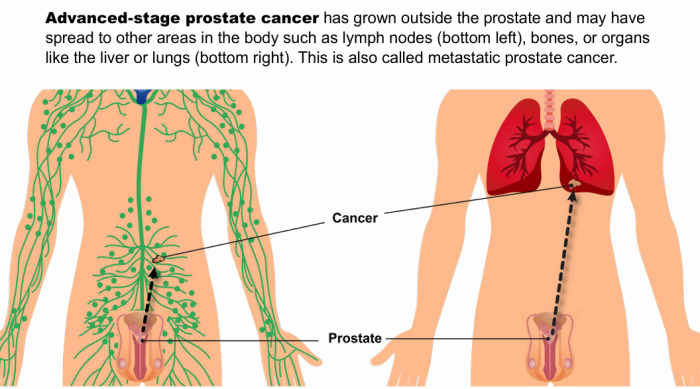 Advanced stage of Prostate cancer