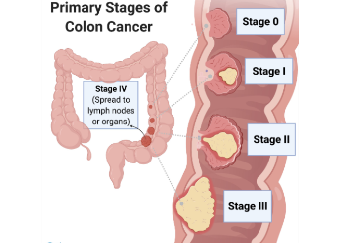 Stages of Colon Cancer