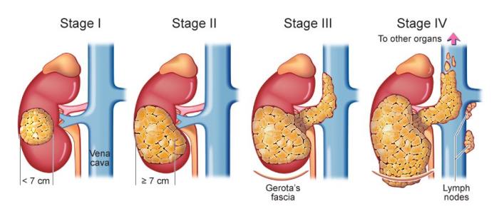 Kidney Cancer Stages