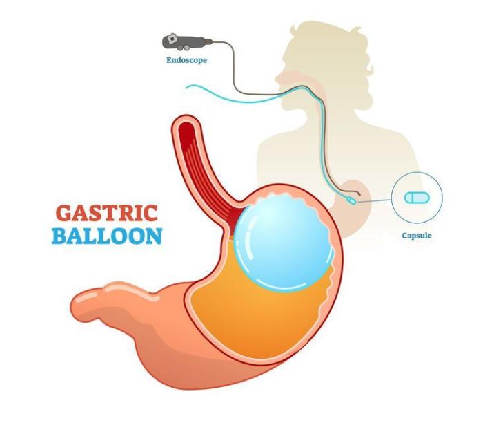 Long-Term Effects of the Intragastric Balloon on Weight Loss