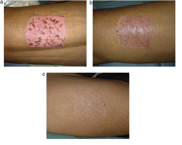 Regeneration of Skin at the Donor Site