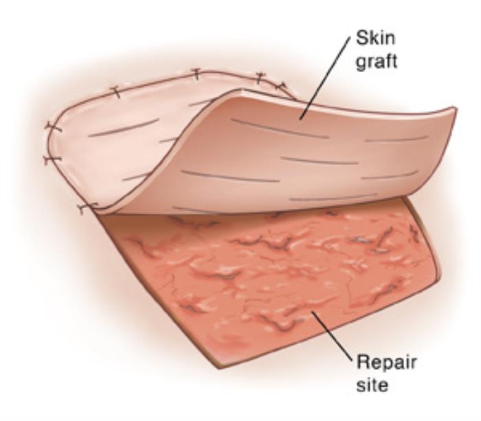 Understanding Skin Grafting