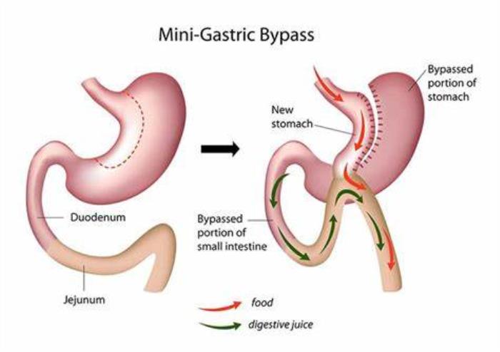 Mini-Gastric Bypass