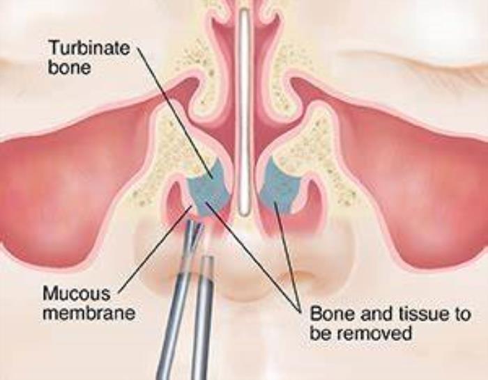 Surgical Techniques That Improve Nasal Breathing