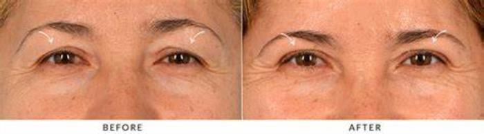 Typical Lifespan of Blepharoplasty Results