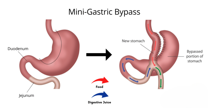 How Mini Gastric Bypass Works