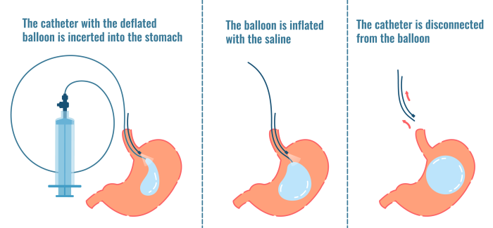 How the Intragastric Balloon is Placed