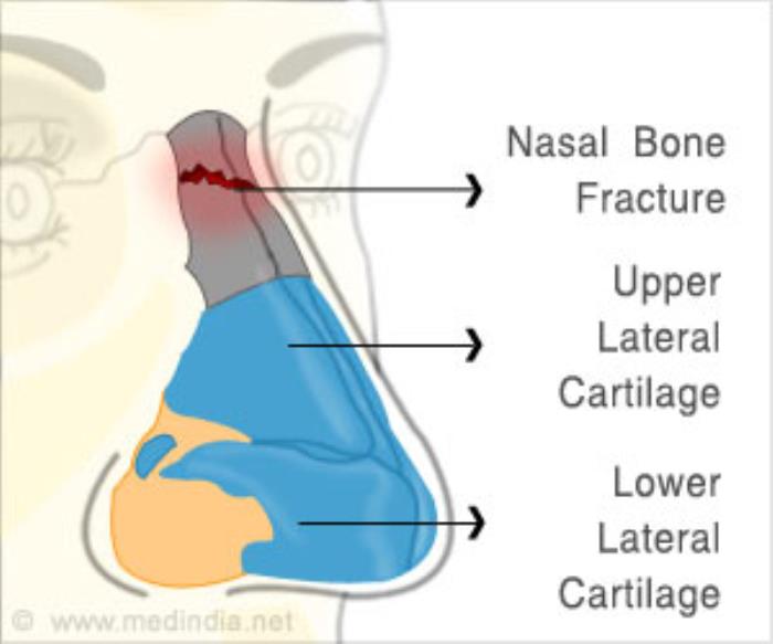 How Rhinoplasty Corrects Nasal Fractures and Deviated Septums