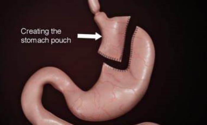 Role of the Stomach Pouch in Limiting Food Consumption