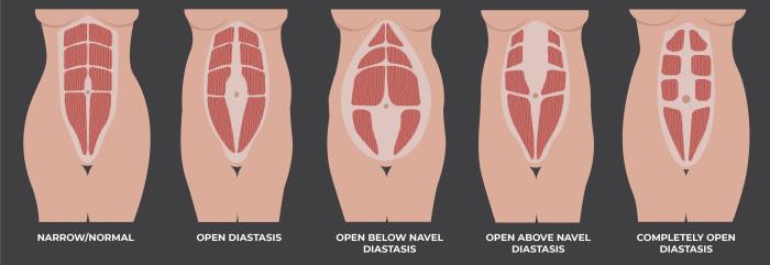 Assessing Abdominal Muscle Separation