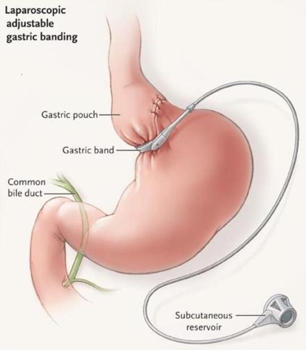 Smart Gastric Bands