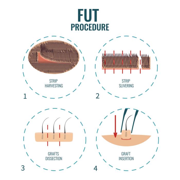 Follicular Unit Transplantation