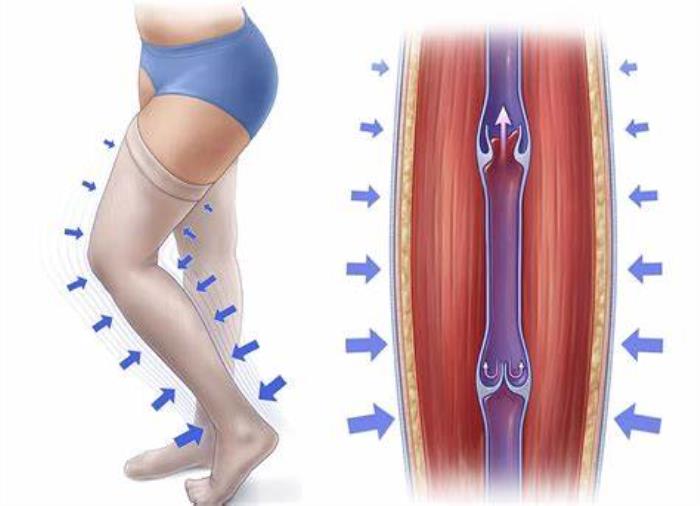 Compression Therapy and Blood Circulation