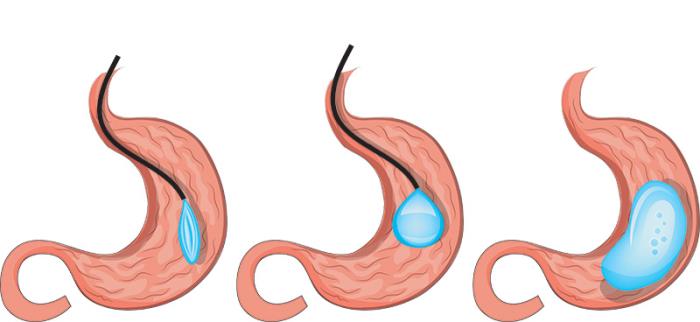 The Role of Fiber in Reducing Hunger and Cravings