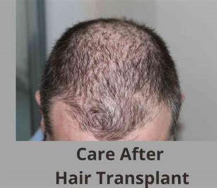 Recommended Hair Products for Transplanted Hair