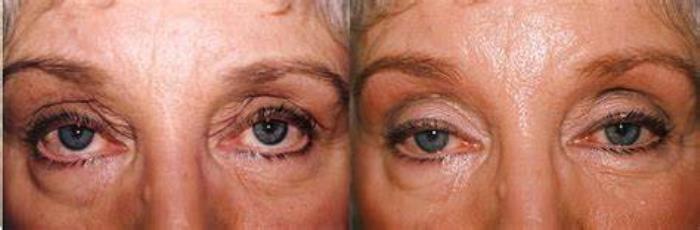 Lifestyle Choices and Their Effect on Eyelid Surgery Longevity