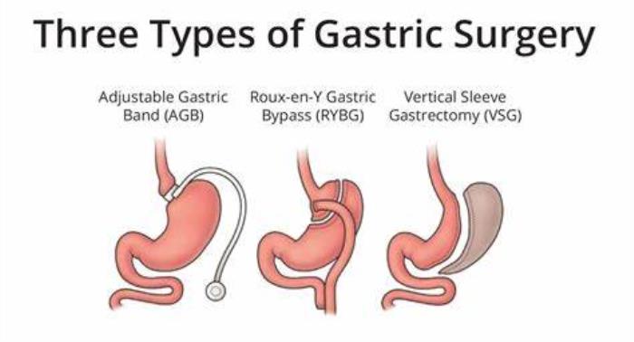 Comparing Mini Gastric Bypass to Other Bariatric Procedures for Diabetes