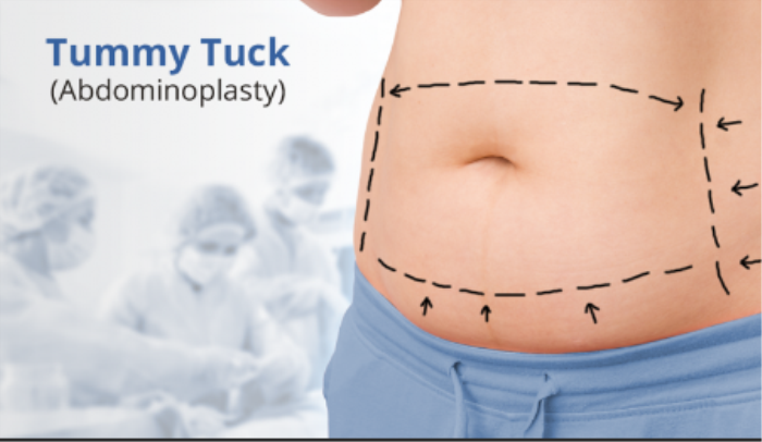 Best surgery for Tummy Tunk treatment in India